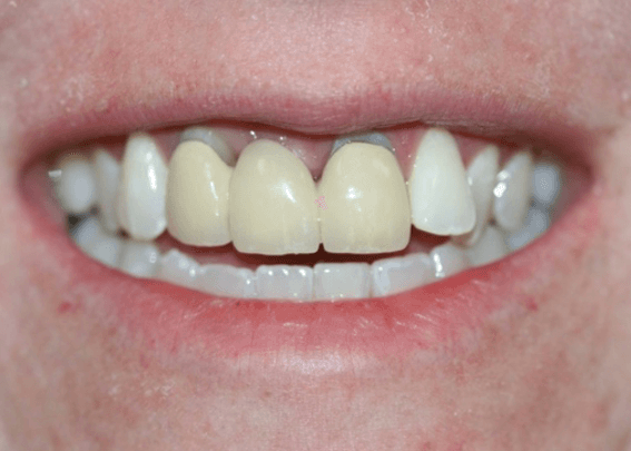 before dental crowns